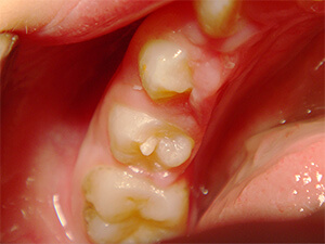 中心結節：歯の形態異常の治療