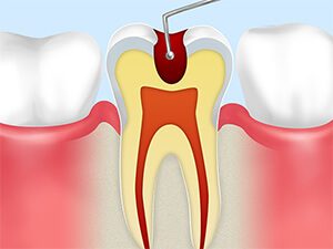 カリエス処置