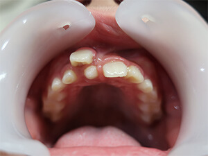 過剰歯抜歯